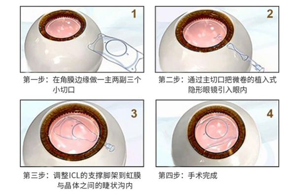 指甲大的一块东西 竟然是拯救高度近视的 法宝 近视手术 近视眼手术的利弊 近视手术的费用 珠海近视眼手术哪里好 珠海近视医院